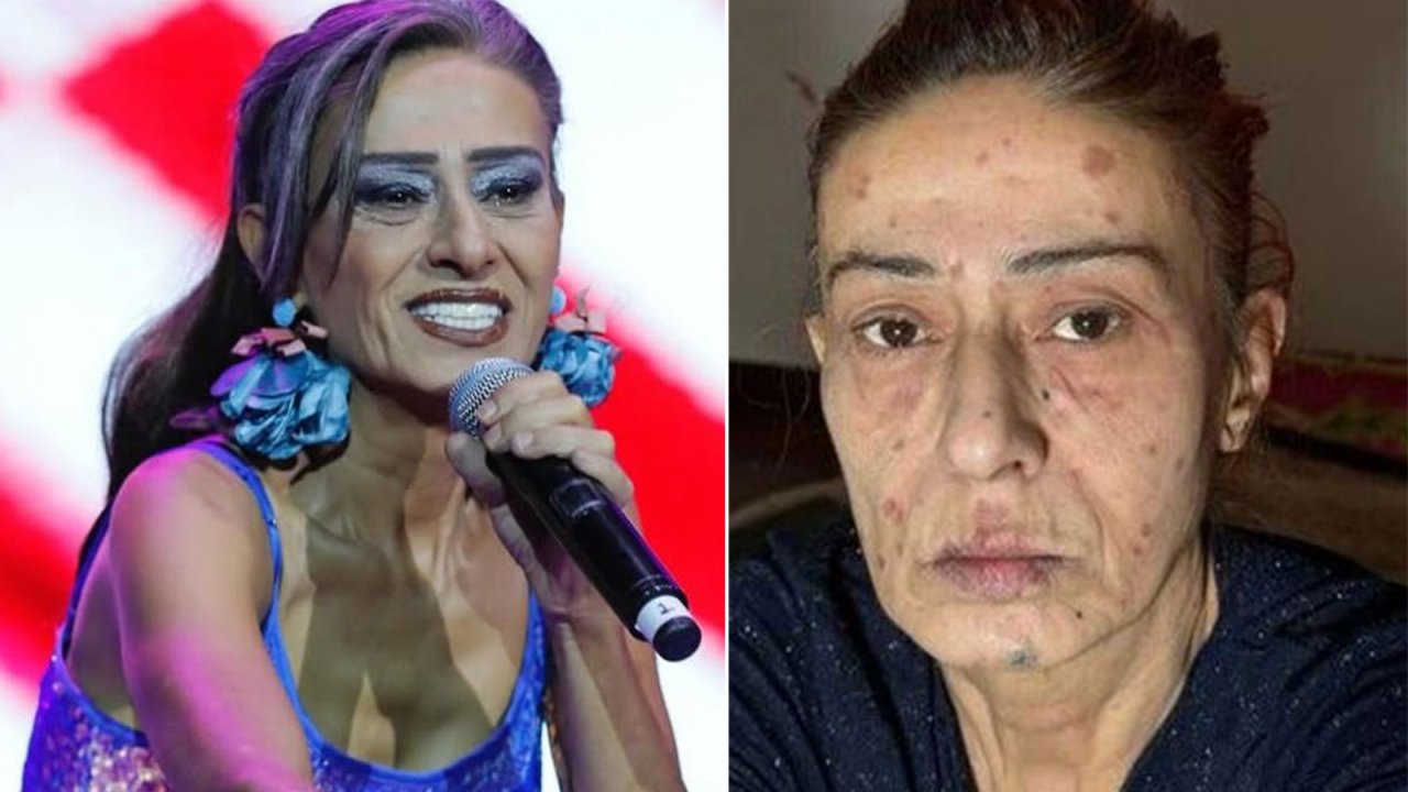Yıldız Tilbe, yüzündeki yanıklarla ilgili son durumu açıkladı! 1 504913